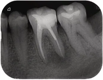 Radiografía a del retratamiento endodóntico de la pieza 36 con periodontitis apical aguda