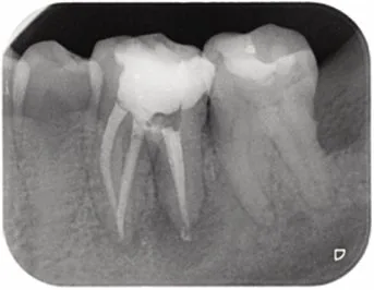 Radiografía b del retratamiento endodóntico de la pieza 36 con periodontitis apical aguda