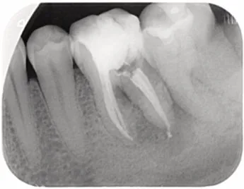 Radiografía c del retratamiento endodóntico de la pieza 36 con periodontitis apical aguda