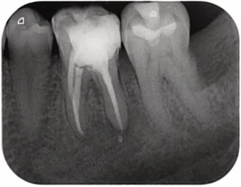 Radiografía d del retratamiento endodóntico de la pieza 36 con periodontitis apical aguda